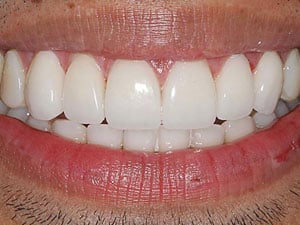 Patient after dental implant treatment