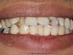 Patient before dental implant treatment