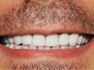 Patient after dental implant treatment