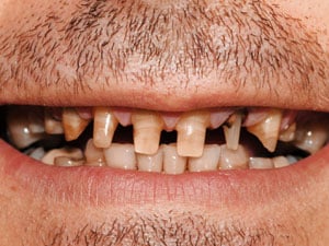 Patient before dental implant treatment