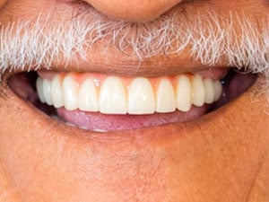 Patient after full arch dental implant treatment