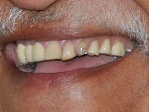 Patient before full arch dental implant treatment
